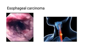 Esophageal carcinoma
 