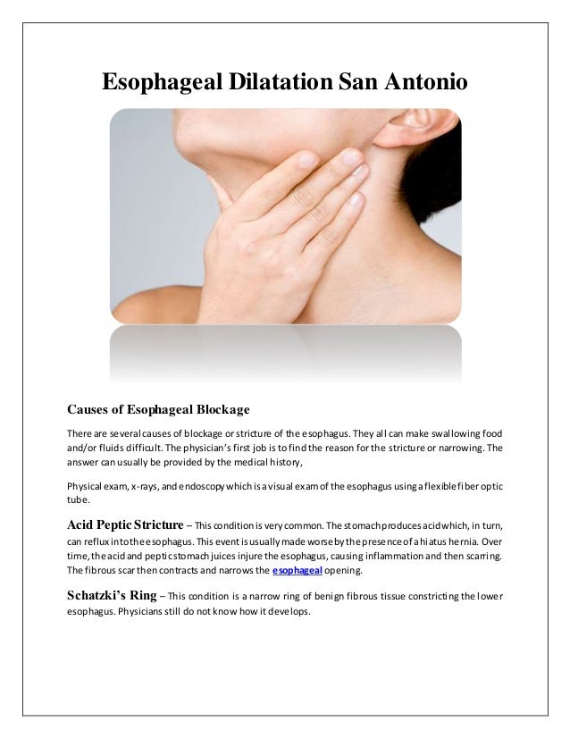 Esophageal Dilatation San Antonio