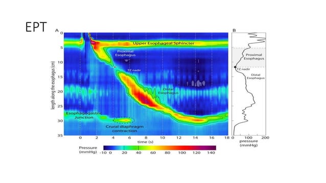 Manometry Reading Esophageal Manometry.pptx | Digestive Disorders | Diseases and Conditions