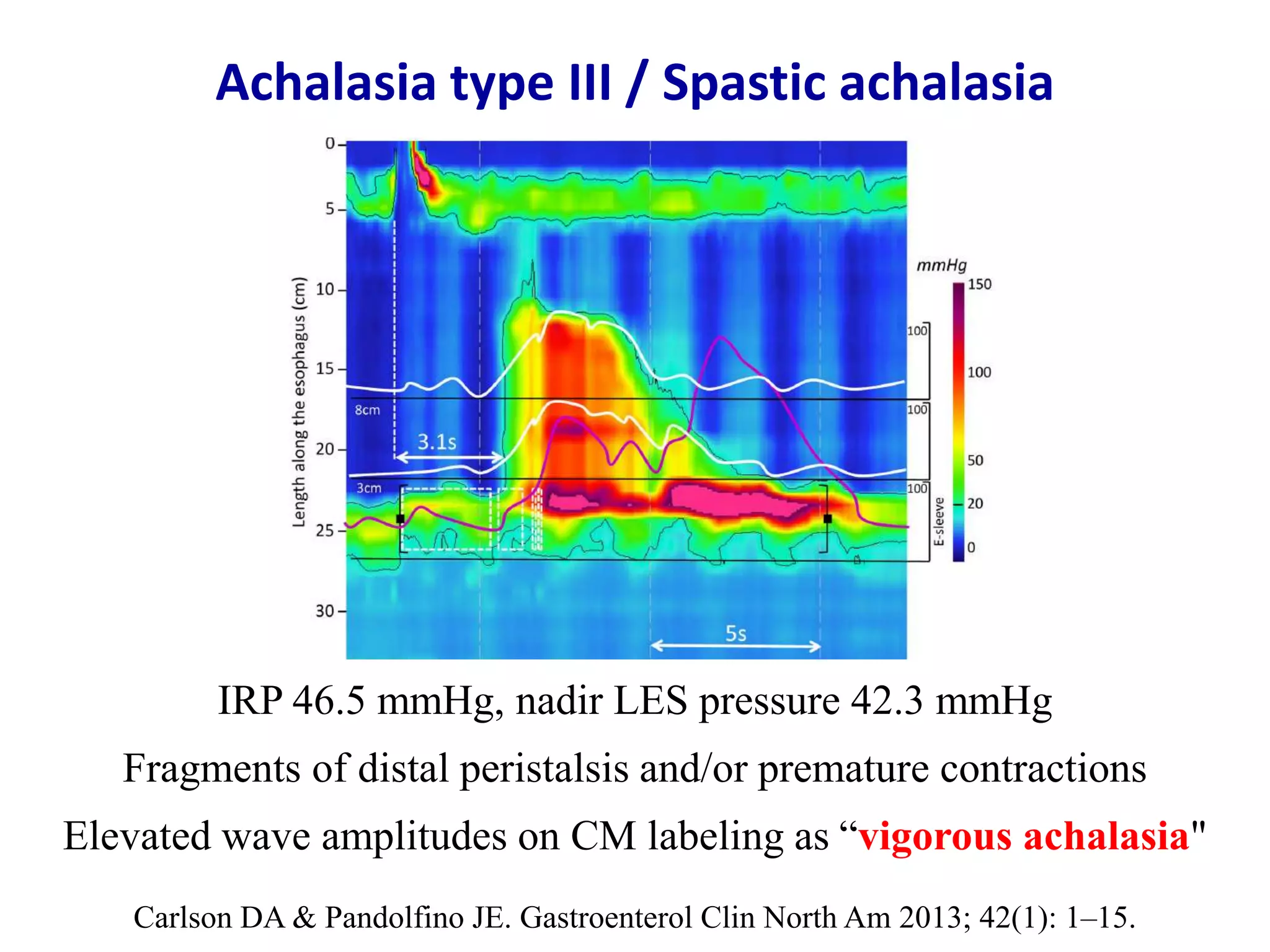 Esophageal motility disorders in Chicago classification v3.0 | PPTX