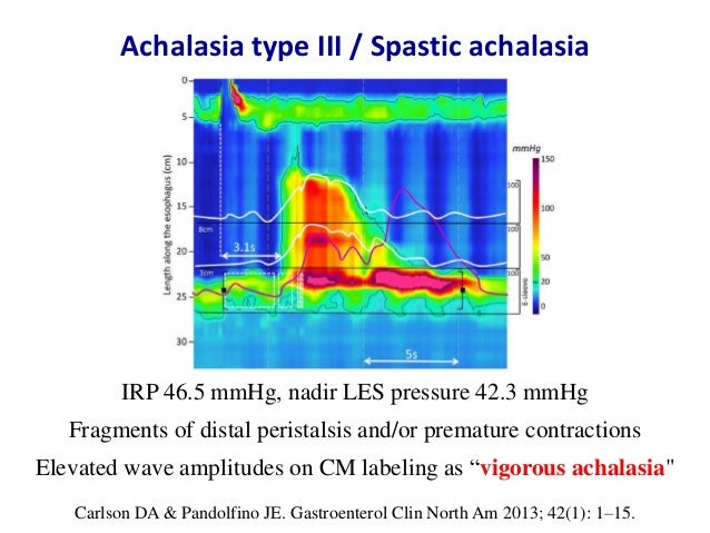 Esophageal motility disorders in Chicago classification v3.0
