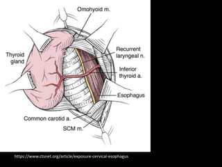 https://www.ctsnet.org/article/exp
osure-cervical-esophagus
 
