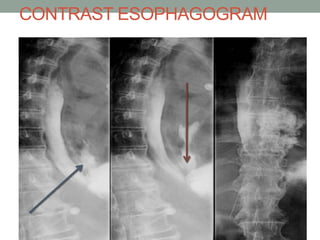 CONTRAST ESOPHAGOGRAM
 