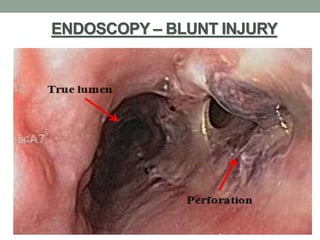 ENDOSCOPY – BLUNT INJURY
 