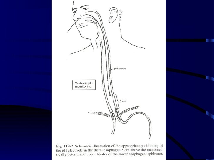 Esophageal p h studies in esophageal disease