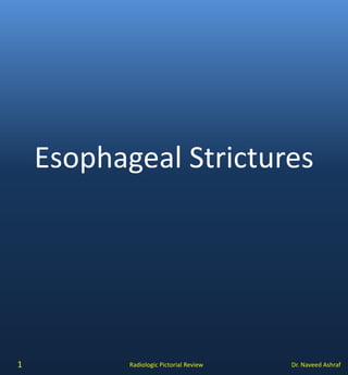 Dr. Naveed AshrafRadiologic Pictorial Review
Esophageal Strictures
1
 