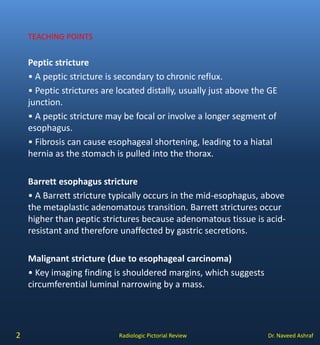 Esophageal Strictures | PDF