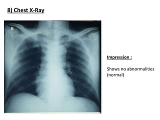 Esophageal Varices X Ray
