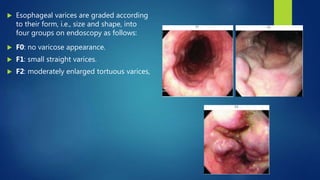  Esophageal varices are graded according
to their form, i.e., size and shape, into
four groups on endoscopy as follows:
 F0: no varicose appearance.
 F1: small straight varices.
 F2: moderately enlarged tortuous varices,
 