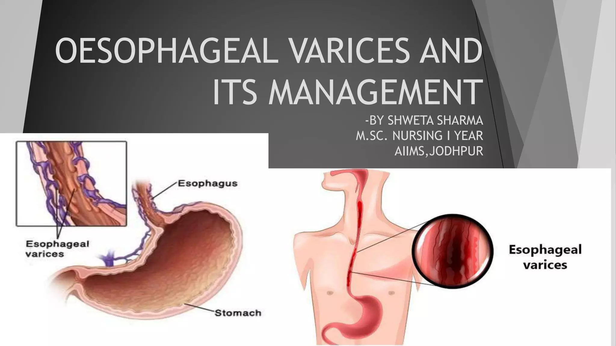 Jsph Varices Classification Esophageal varices | PPT