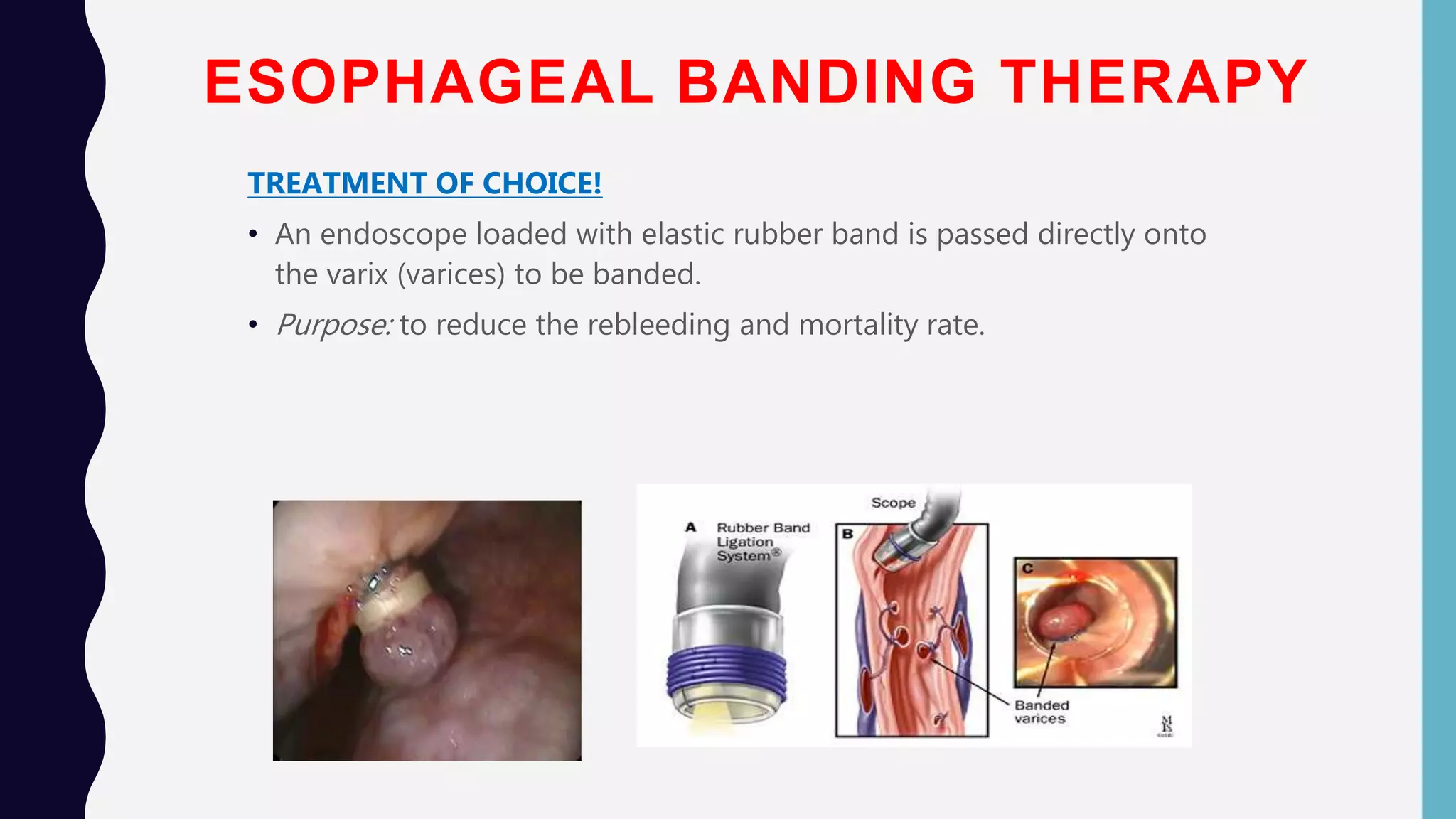 Esophageal Varices PPSX esophageal-varices-ppsx