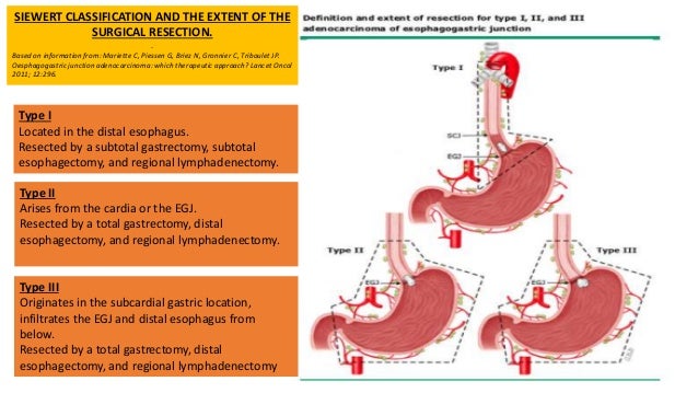 Esophagectomy Approaches Controversies And Current Evidence