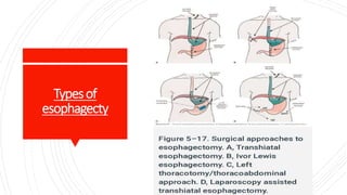 Typesof
esophagecty
 