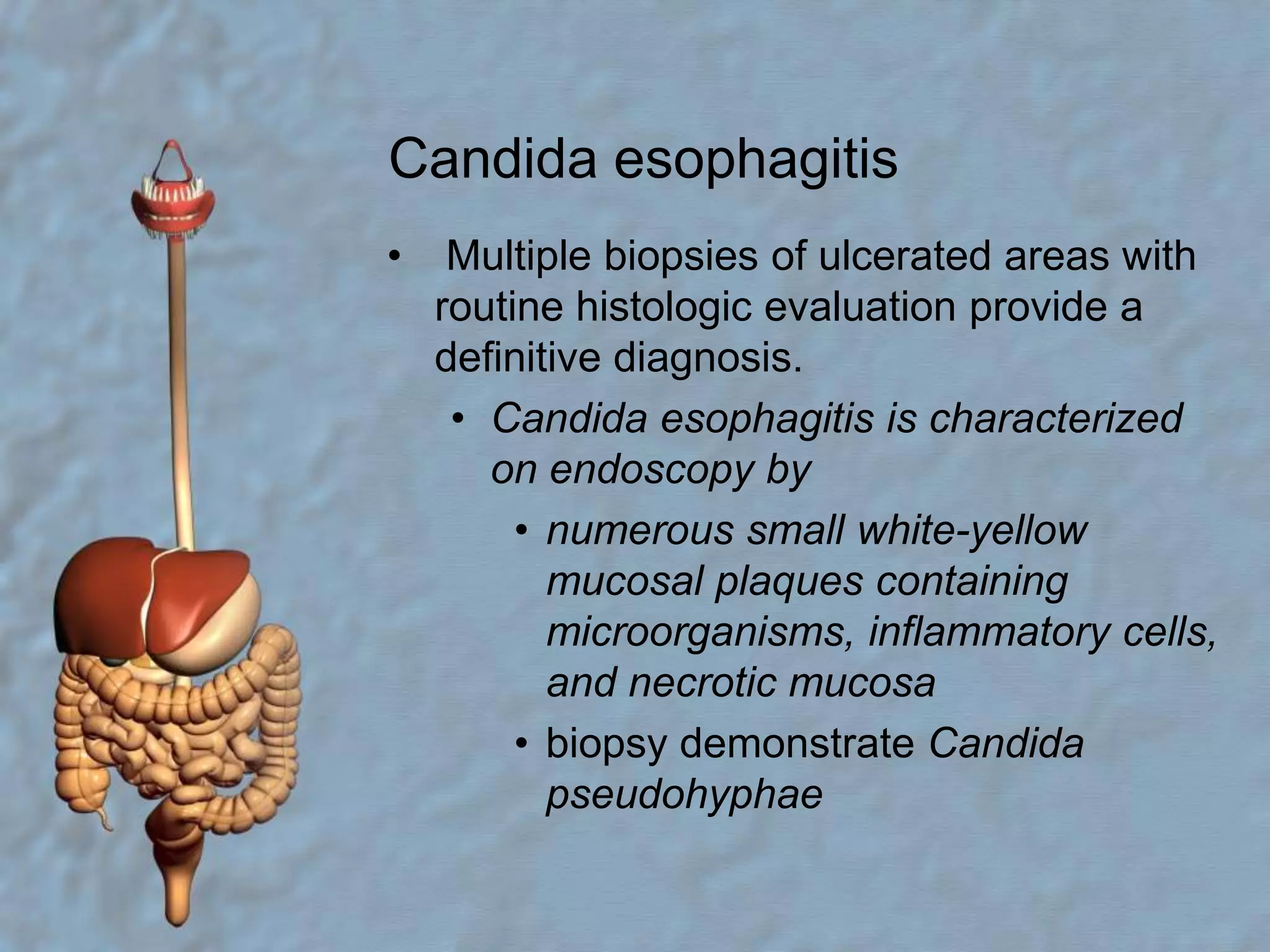 Esophagitis | PPTX