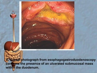 B, Digital photograph from esophagogastroduodenoscopy confirms the presence of an ulcerated submucosal mass within the duodenum.