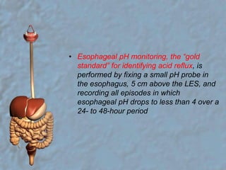 Esophageal pH monitoring, the “gold standard” for identifying acid reflux, is performed by fixing a small pH probe in the esophagus, 5 cm above the LES, and recording all episodes in which esophageal pH drops to less than 4 over a 24- to 48-hour period