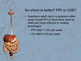 So which is better? PPI or H2B?Heartburn relief rate in a symptom relief study shows PPI to have more rapid sx relief and more effective in healing esophagitisPPI relief 11.5% per weekH2 relief 6.4% per week