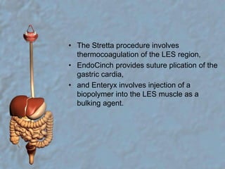 The Stretta procedure involves thermocoagulation of the LES region, EndoCinch provides suture plication of the gastric cardia, and Enteryx involves injection of a biopolymer into the LES muscle as a bulking agent. 