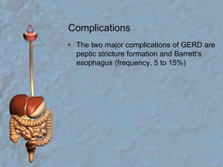 ComplicationsThe two major complications of GERD are peptic stricture formation and Barrett's esophagus (frequency, 5 to 15%)