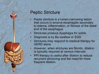 Peptic StricturePeptic stricture is a lumen-narrowing lesion that occurs in erosive esophagitis secondary to edema, inflammation, or fibrosis of the distal end of the esophagus Strictures produce dysphagia for solidsDiagnosis is by Ba swallow or EGDStrictures may respond to medical therapy for GERD alone. However, when strictures are fibrotic, dilation is typically required at various intervals. PPI therapy is useful after dilation to reduce recurrent stricturing and the need for more frequent dilation. 