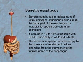 Barrett’s esophagusBarrett's esophagus is replacement of reflux-damaged squamous epithelium in the distal part of the esophagus by metaplastic, specialized columnar epithelium.It is found in 10 to 15% of patients with GERD, principally in white individuals.The lesion is suspected on endoscopy by the presence of reddish epithelium extending from the stomach into the tubular lumen of the esophagus