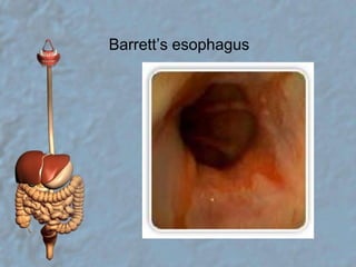 Barrett’s esophagus