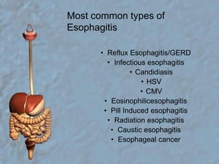Most common types of EsophagitisReflux Esophagitis/GERDInfectious esophagitisCandidiasisHSVCMVEosinophilicesophagitisPill Induced esophagitisRadiation esophagitisCaustic esophagitisEsophageal cancer