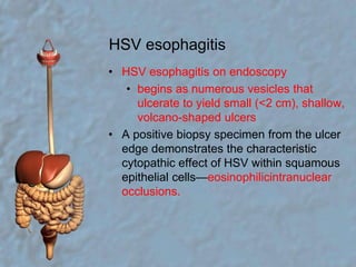 HSV esophagitisHSV esophagitis on endoscopybegins as numerous vesicles that ulcerate to yield small (<2 cm), shallow, volcano-shaped ulcersA positive biopsy specimen from the ulcer edge demonstrates the characteristic cytopathic effect of HSV within squamous epithelial cells—eosinophilicintranuclear occlusions.