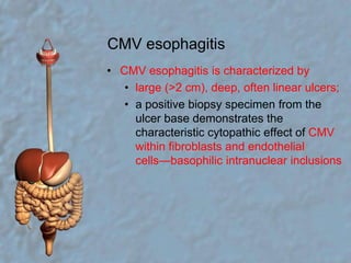 CMV esophagitisCMV esophagitis is characterized bylarge (>2 cm), deep, often linear ulcers;a positive biopsy specimen from the ulcer base demonstrates the characteristic cytopathic effect of CMV within fibroblasts and endothelial cells—basophilic intranuclear inclusions
