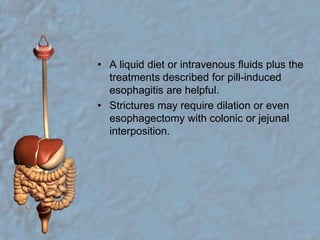 A liquid diet or intravenous fluids plus the treatments described for pill-induced esophagitis are helpful. Strictures may require dilation or even esophagectomy with colonic or jejunal interposition.
