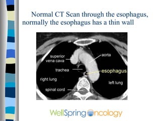 Normal CT Scan through the esophagus, normally the esophagus has a thin wall 