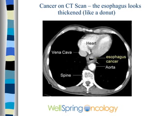 Cancer on CT Scan – the esophagus looks thickened (like a donut) 