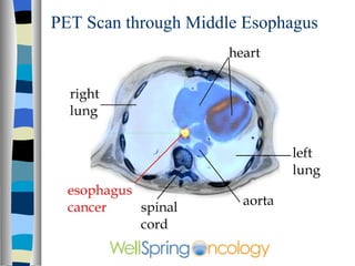 PET Scan through Middle Esophagus 