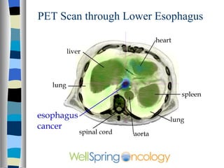 PET Scan through Lower Esophagus 