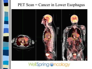 PET Scan = Cancer in Lower Esophagus 
