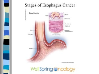 Stages of Esophagus Cancer 