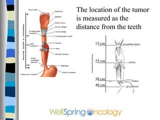 The location of the tumor is measured as the distance from the teeth 