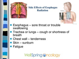 Side Effects of Esophagus    Radiation Esophagus – sore throat or trouble swallowing Trachea or lungs – cough or shortness of breath Chest wall – tenderness Skin – sunburn Fatigue 