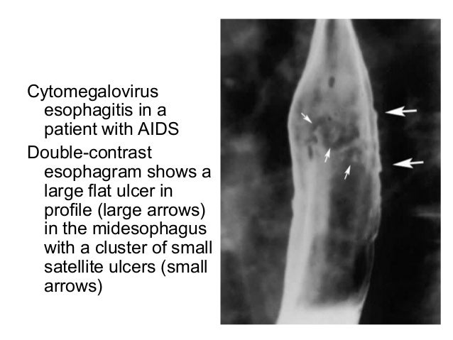 Diagnositc Imaging of the Esophagus