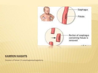 KAMRON HAIGHTS
Exciaion of fistula f/b esophagoesophagostomy
 