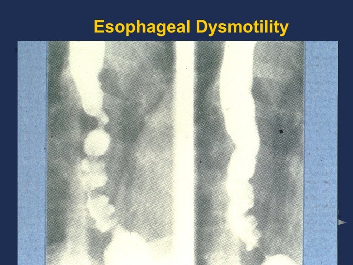Esophagus Ppt Surgery Lect#2