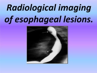 Radiological imaging
of esophageal lesions.
 