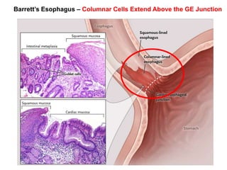 Barrett’s Esophagus – Columnar Cells Extend Above the GE Junction 
 