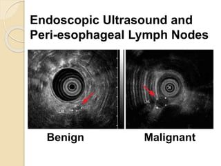 Endoscopic Ultrasound and 
Peri-esophageal Lymph Nodes 
Benign Malignant 
 