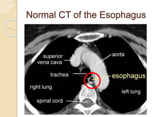 Normal CT of the Esophagus 
 