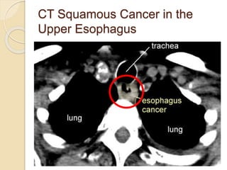 CT Squamous Cancer in the 
Upper Esophagus 
 