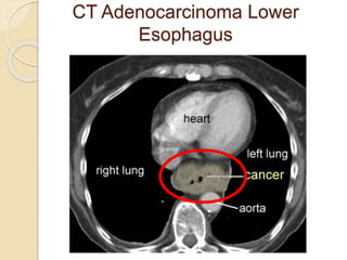 CT Adenocarcinoma Lower 
Esophagus 
 