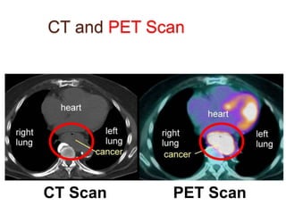 CT and PET Scan 
CT Scan PET Scan 
 