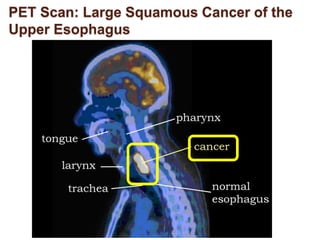 PET Scan: Large Squamous Cancer of the 
Upper Esophagus 
 