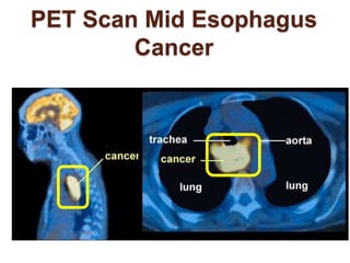 PET Scan Mid Esophagus 
Cancer 
 
